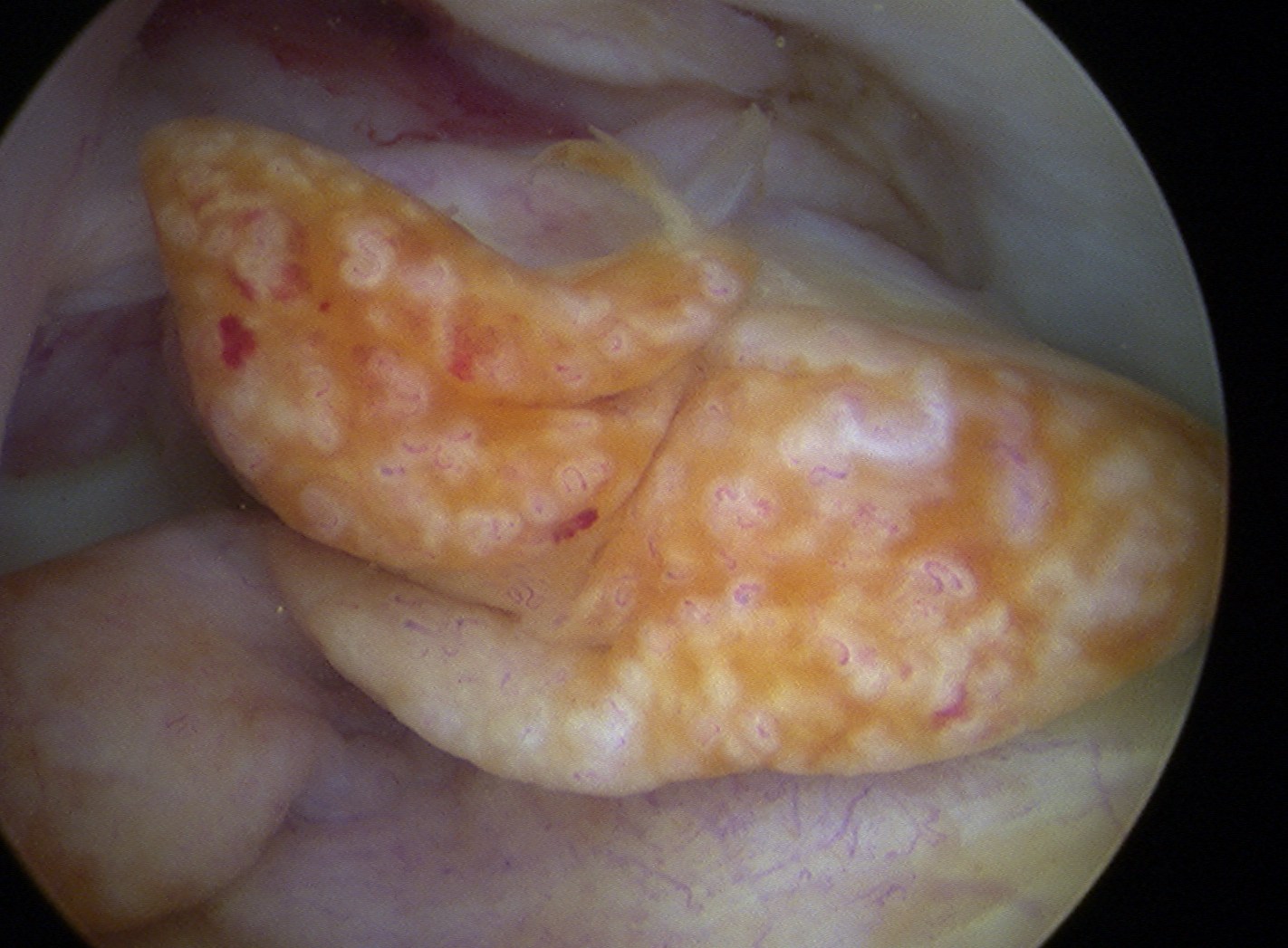 ACL Stump Arthroscopy